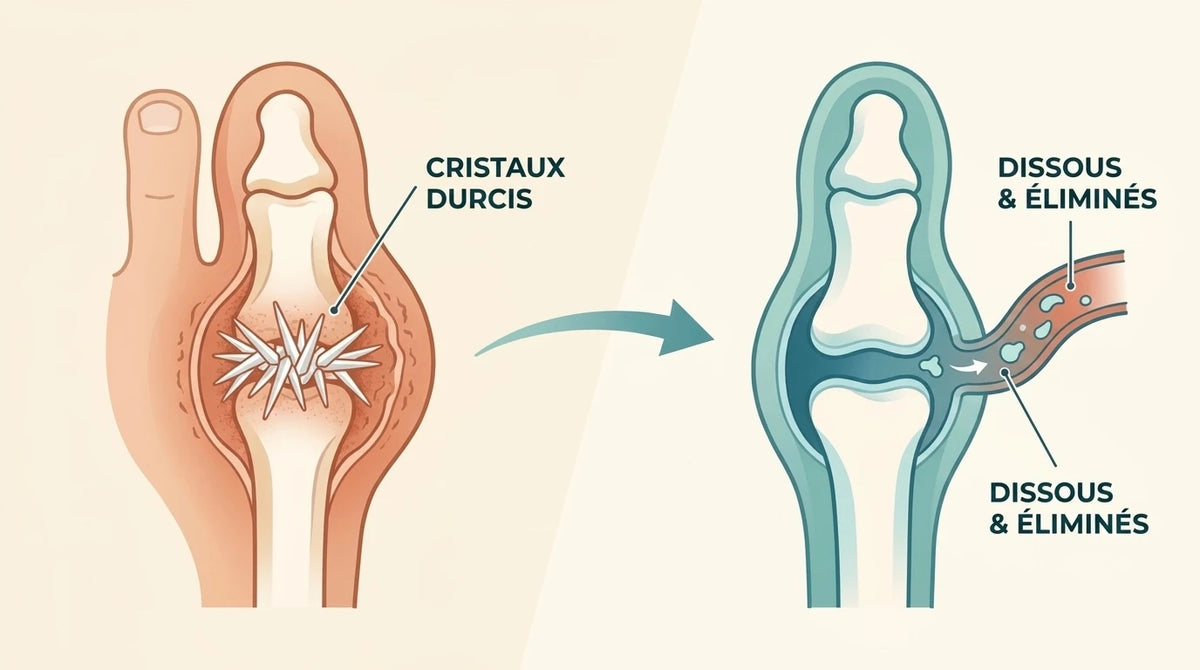 Schéma des cristaux d'acide urique dissous dans l'articulation